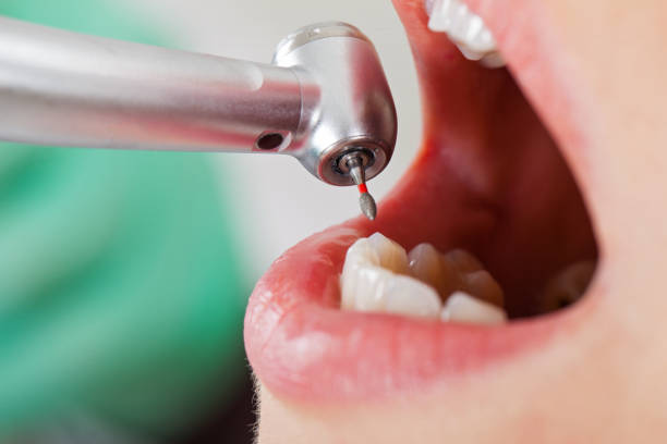 Best Chipped Tooth Repair Near Me  in Winchester, CA
